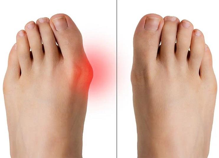 هالوکس والگوس یا انحراف شست پا چگونه درمان می‌شود؟
