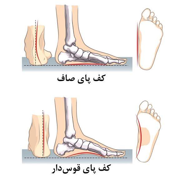 دلایل بروز کف پای صاف