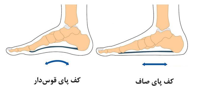 انواع کف پای صاف