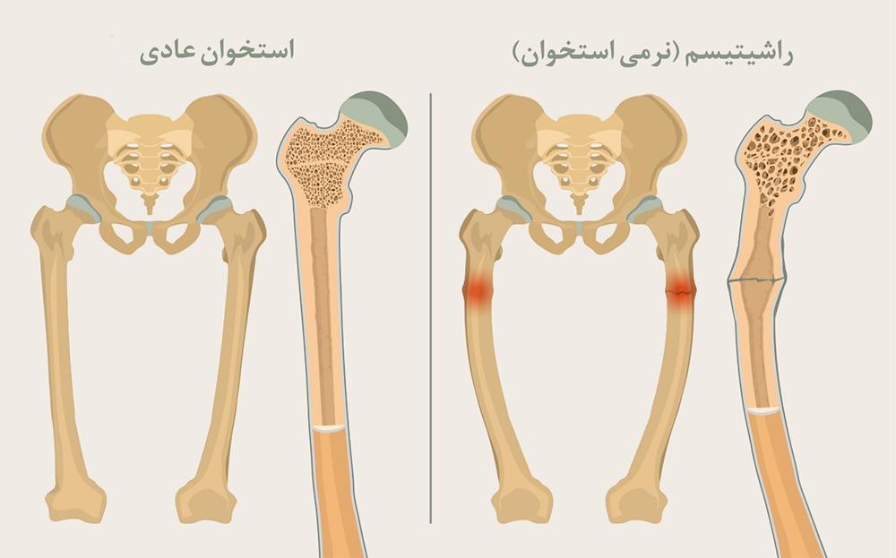 نرمی استخوان 