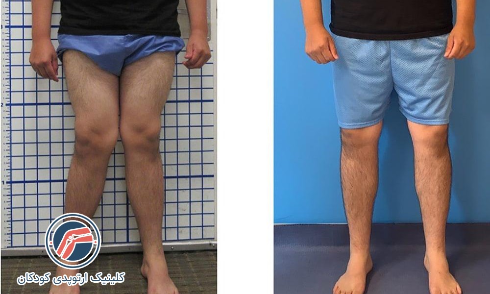 آیا زانو ضربدری خطرناک است؟