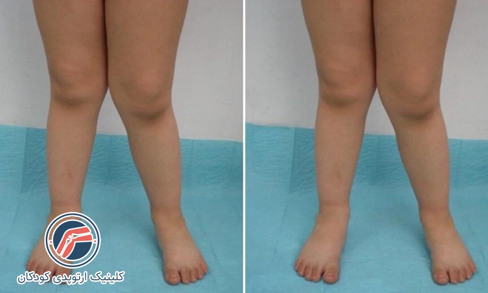 درمان زانو ضربدری کودکان و بزرگسالان بدون جراحی و با ورزش