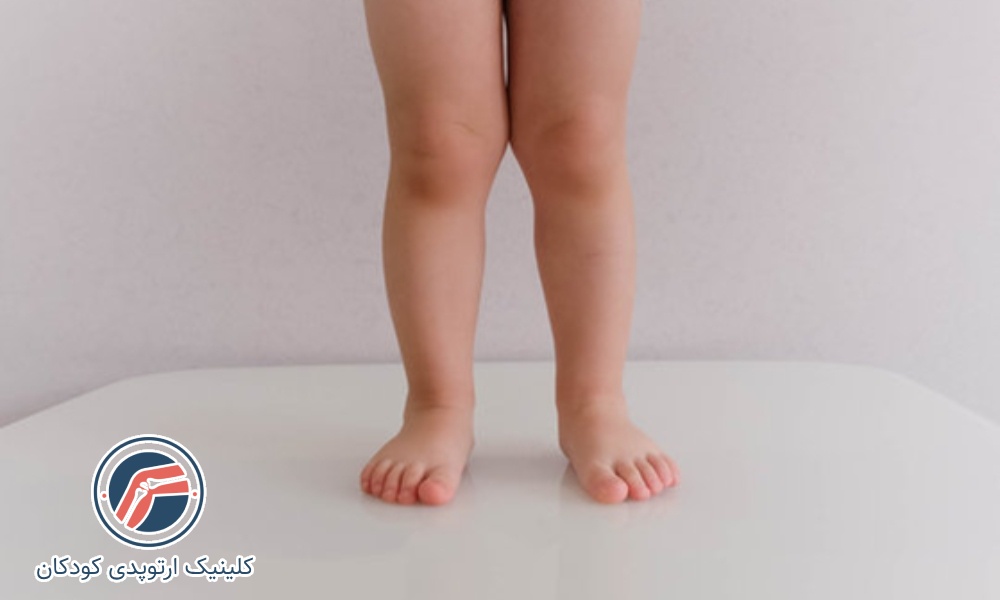 زانو ضربدری خفیف