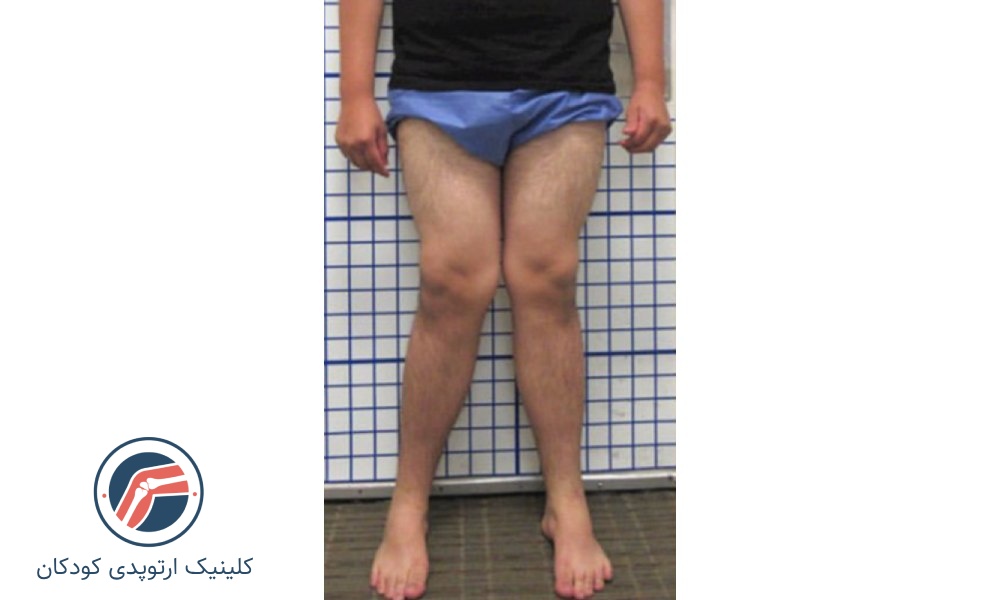 زانوضربدری شدید