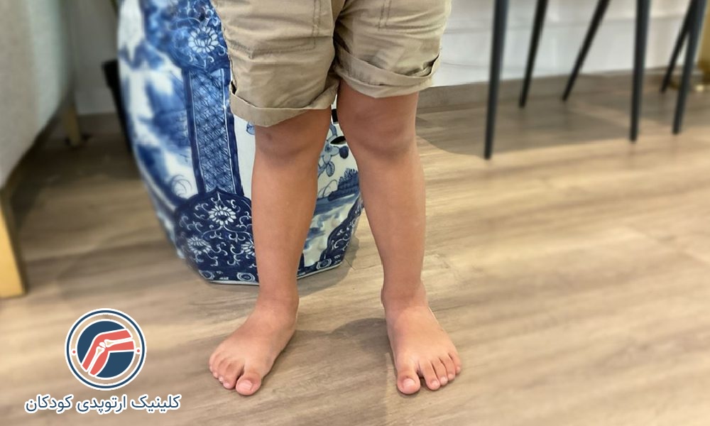 زانون ضربدری متوسط