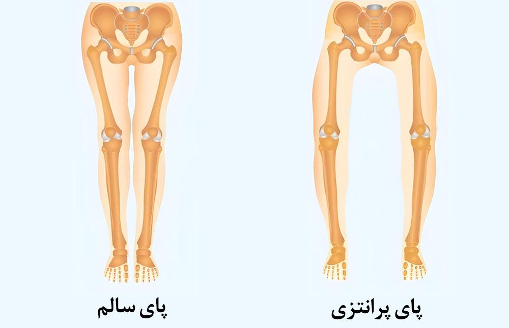 پای پرانتزی چیست؟