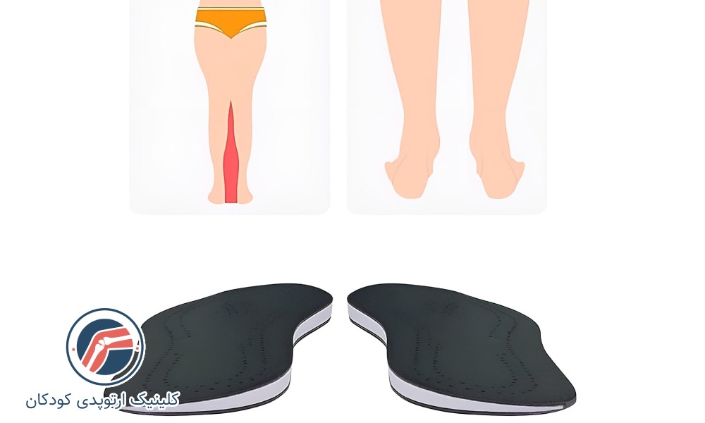 کفش و کفی مناسب زانو ضربدری