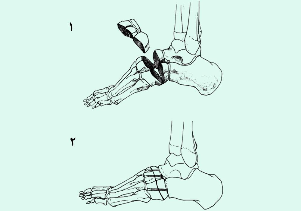 درمان قوس زیاد کف پا با جراحی