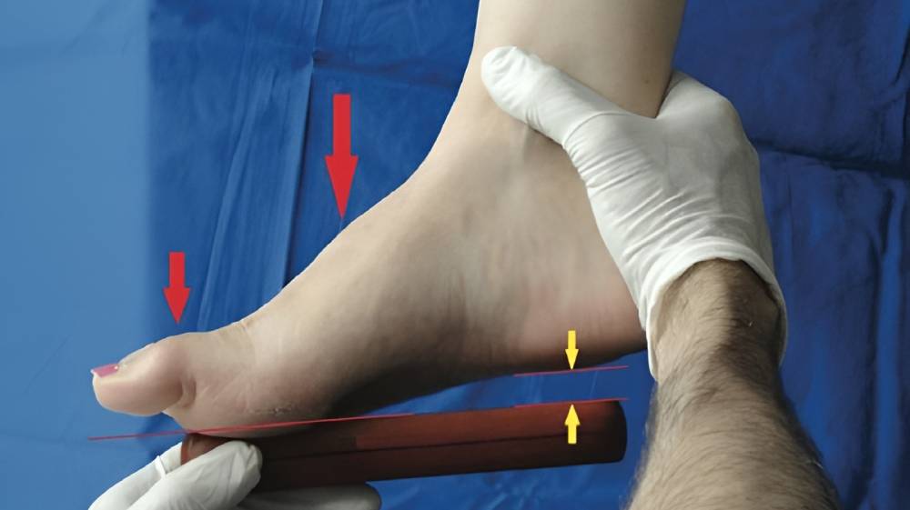 تشخیص قوس زیاد کف پا