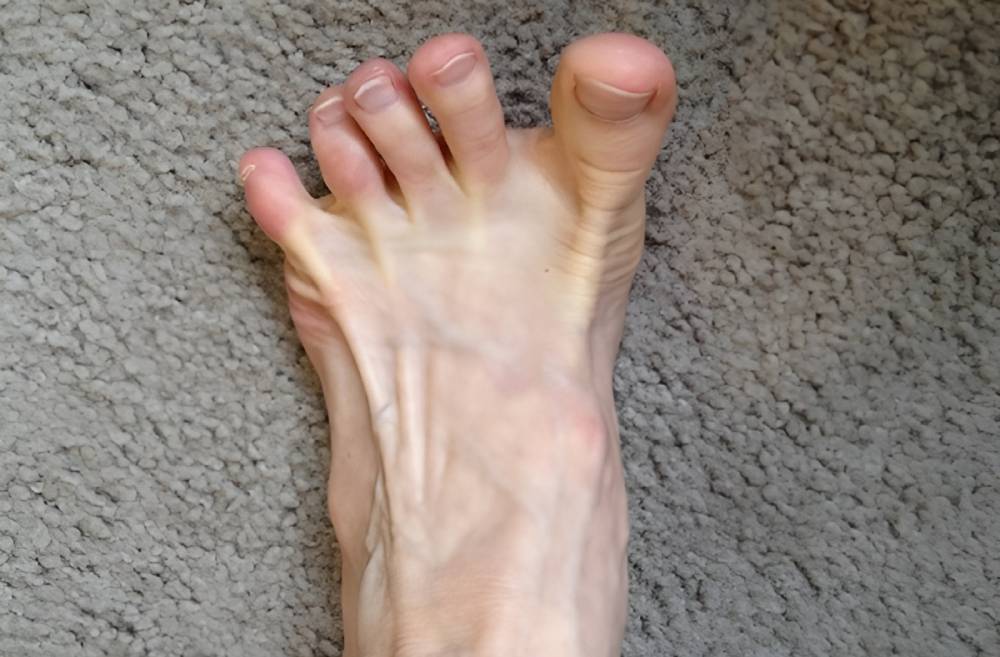 تمرین باز و بسته کردن انگشتان برای اصلاح قوس زیاد کف پا