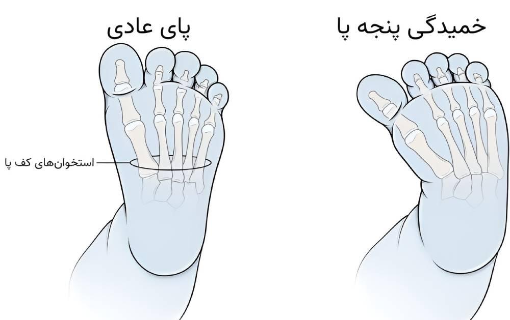 خمیدگی پنجه‌پا