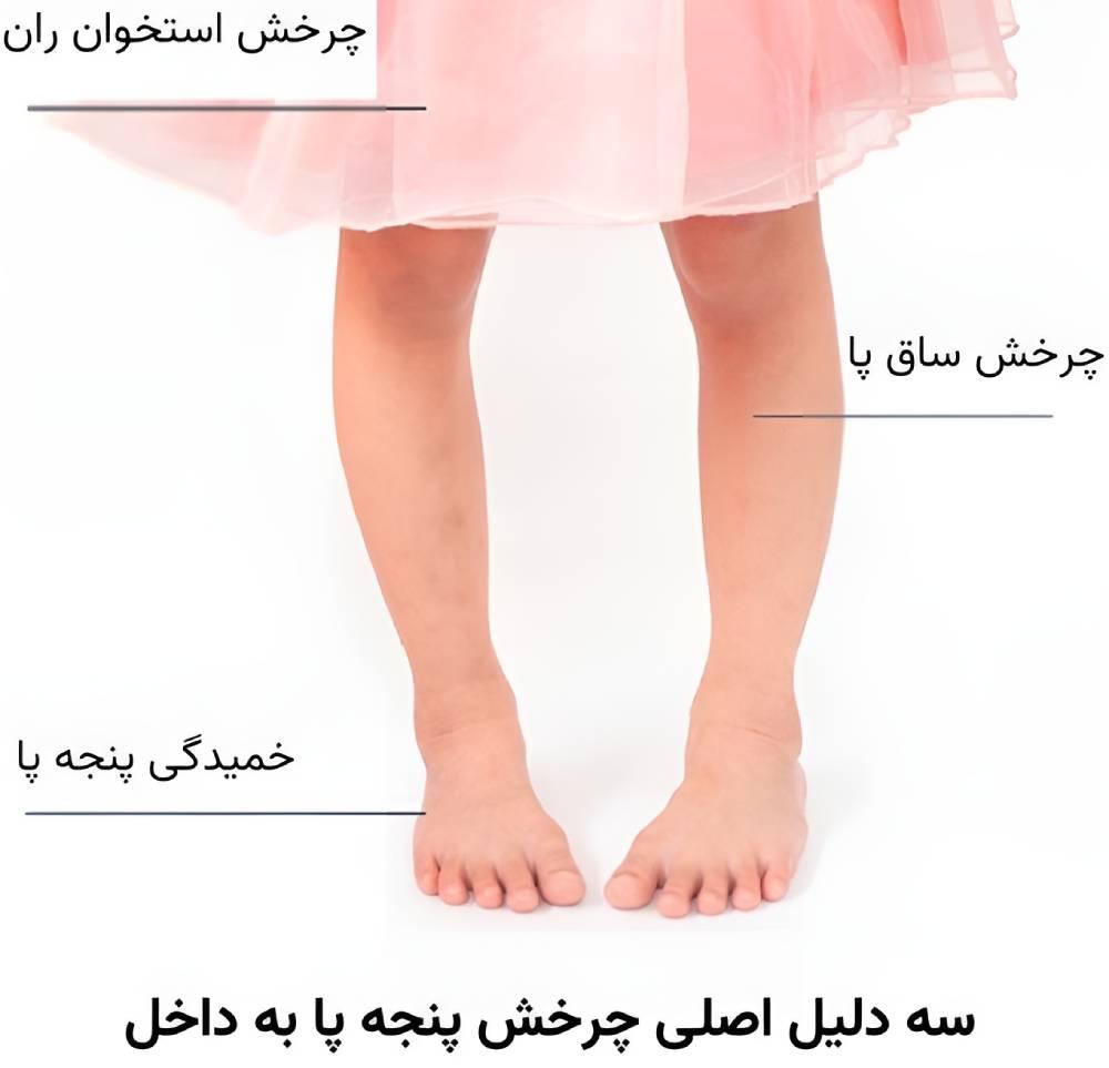 دلایل بروز چرخش پنجه پا به داخل