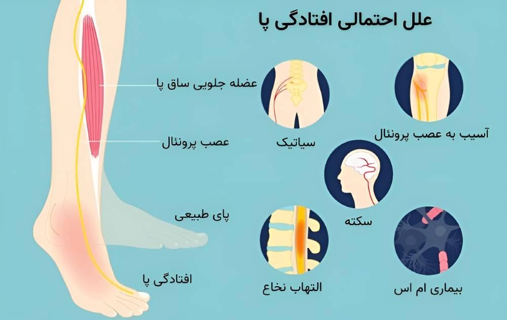علت افتادگی پا