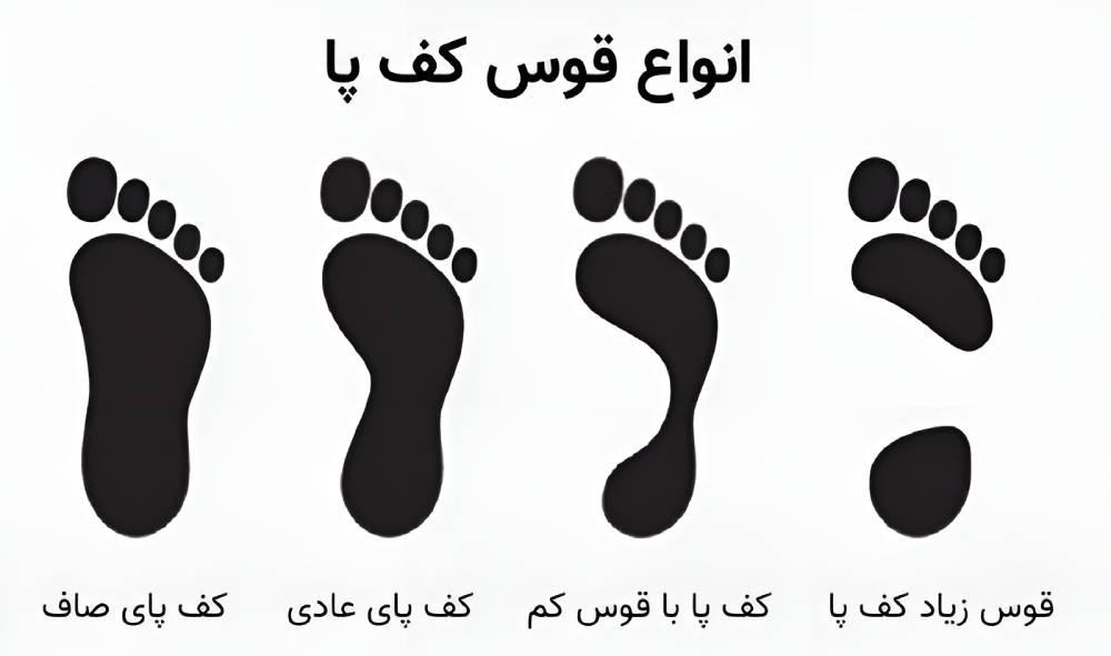 گودی قوس کف پا چه زمانی زیاد محسوب میشود؟