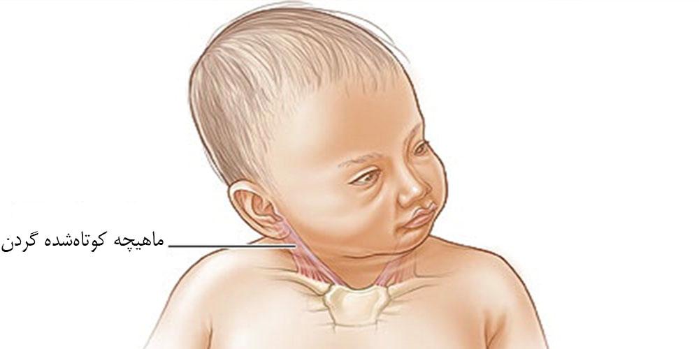 تورتیکولی گردن