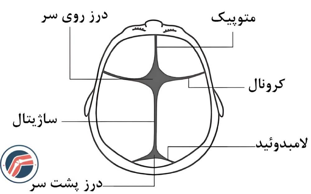 بدشکلی سر نوزاد چیست؟