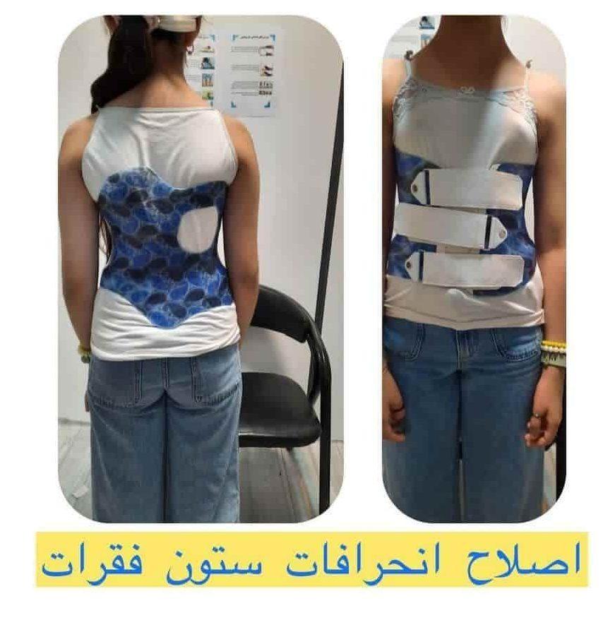 بریس برای درمان اسکولیوز