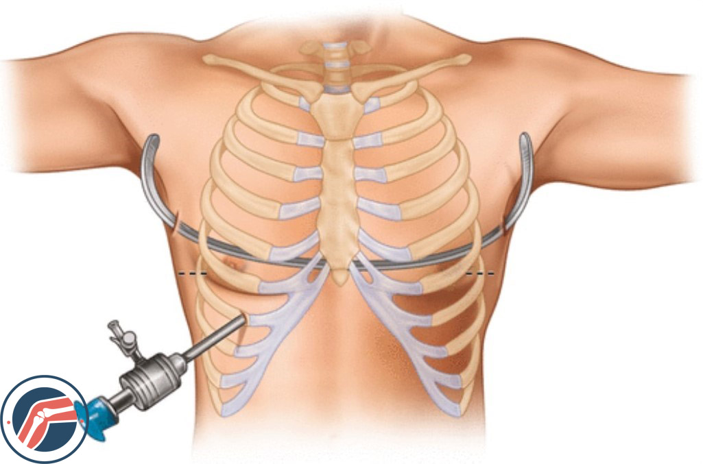 درمان و کنترل فرورفتگی قفسه سینه با جراحی به روش ناس Nuss 