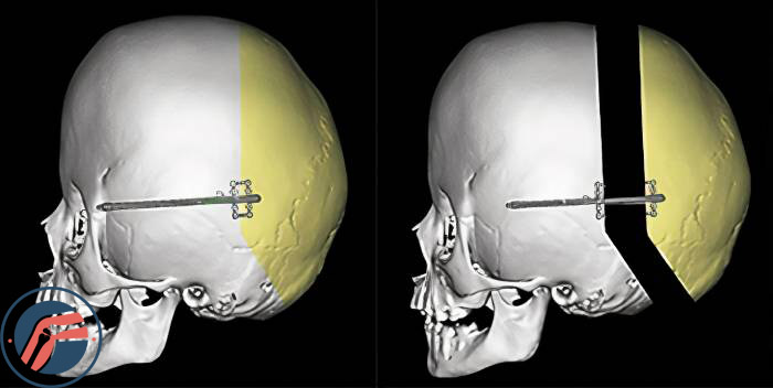 دیستراکشن جمجمه (Cranial Vault Distraction یا Cranial Distraction) برای درمان بدشکلی سر نوزادان