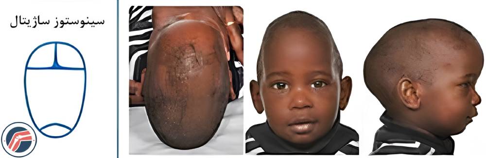 سینوستوز ساژیتال