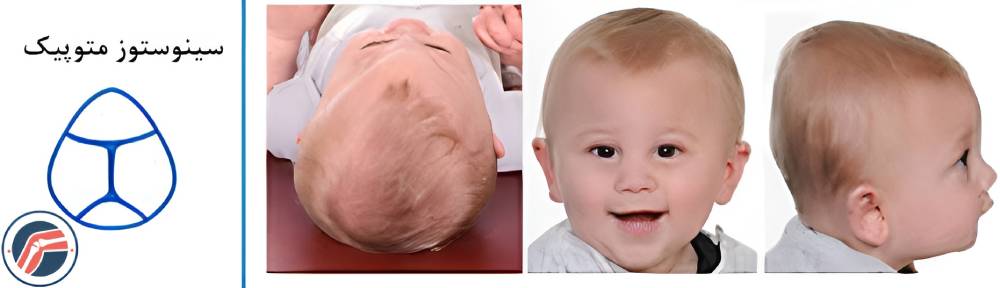 سینوستوز متوپیک