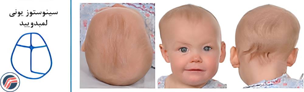 سینوستوز یونی لامبدوئید