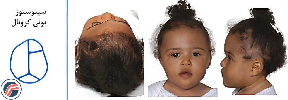 سینوستوز یونی کرونال