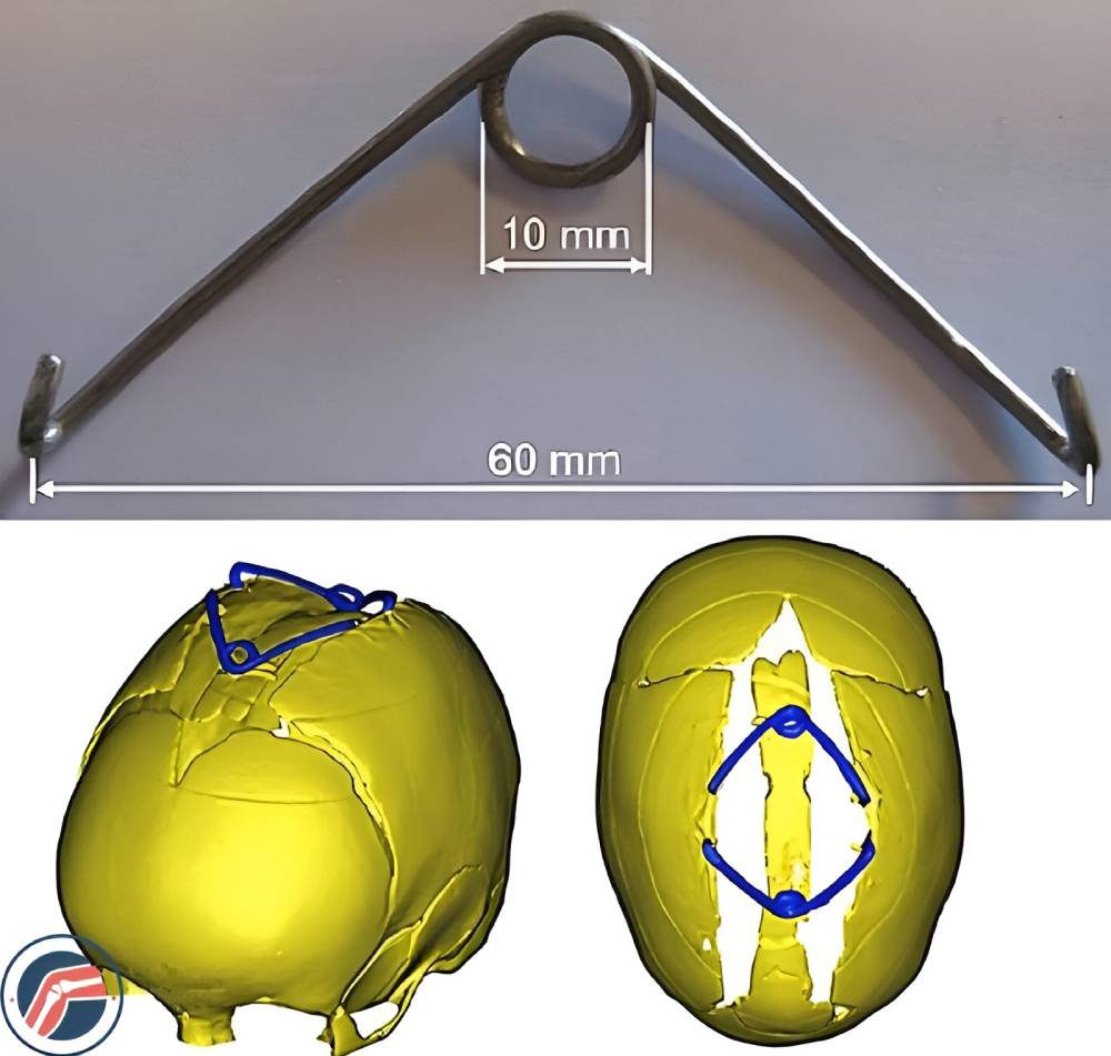 فنرهای جمجمه ای برای درمان بدشکلی سر نوزادان