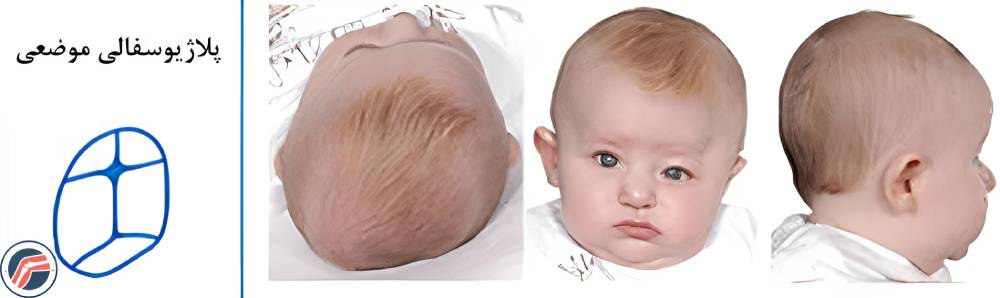 پلاژیوسفالی موضعی