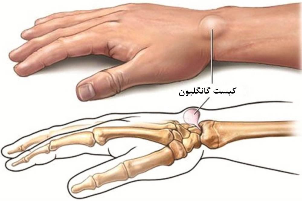 برآمدگی روی مچ دست چیست؟