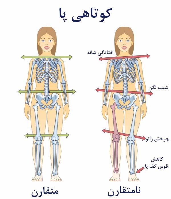 شانه نابرابر بر اثر کوتاهی پا