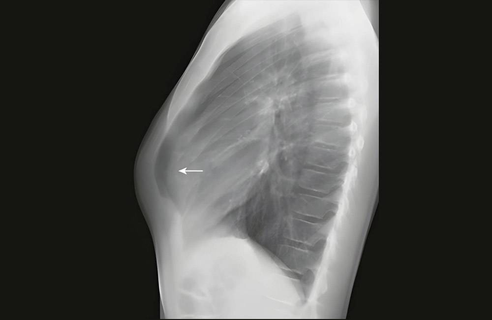 تصاویربرداری اشعه ایکس برای تشخیص سینه کبوتری 