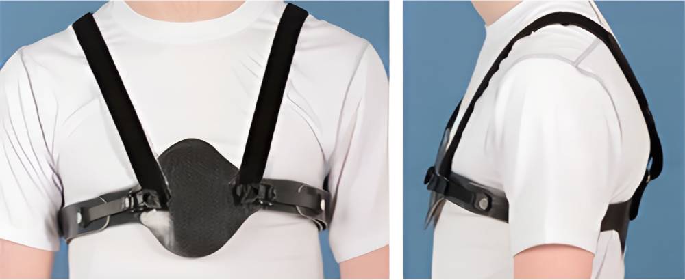 درمان عارضه سینه کبوتری با استفاده از بریس