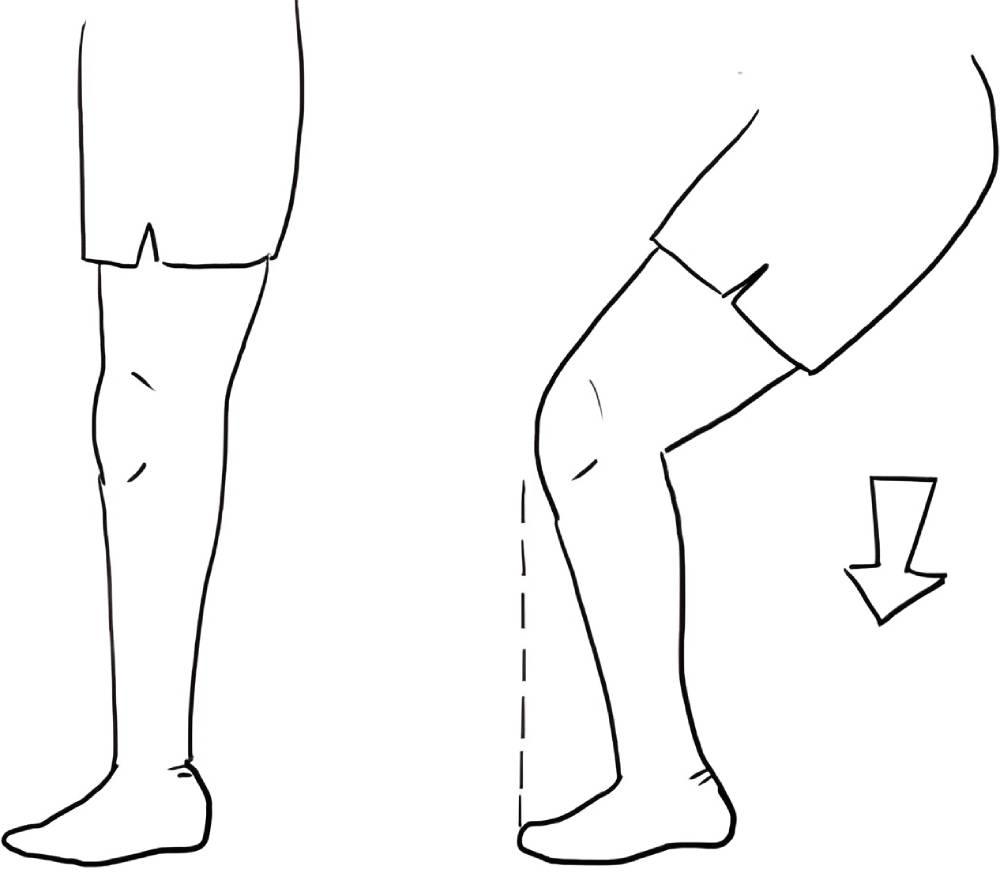 تمرین اسکات برای درمان عقب‌زدگی زانو