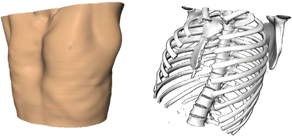 اسکن سه بعدی برای تشخیص سینه کبوتری