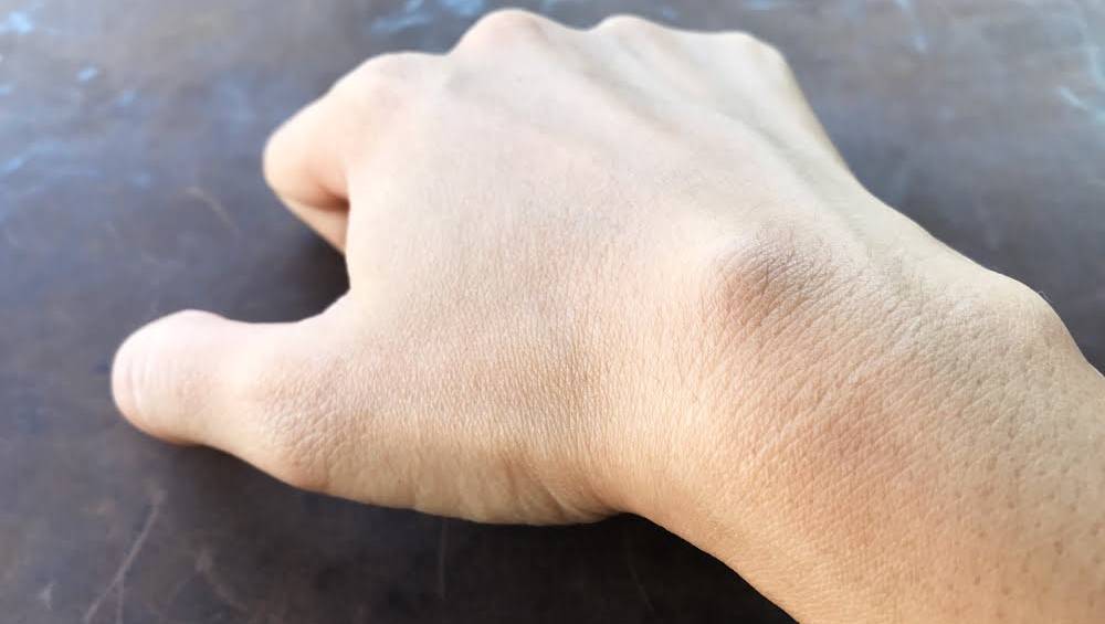 برای برآمدگی روی مچ دست، چه زمانی باید به پزشک مراجعه کرد