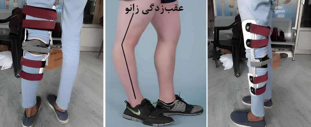 درمان عقب‌زدگی زانو با بریس یا زانوبند طبی