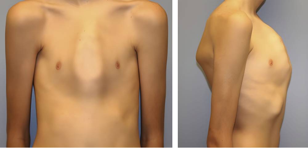 بیرون زدگی کندروگلادیولار