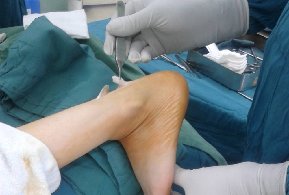 درمان راه رفتن روی پنجه پا با جراحی