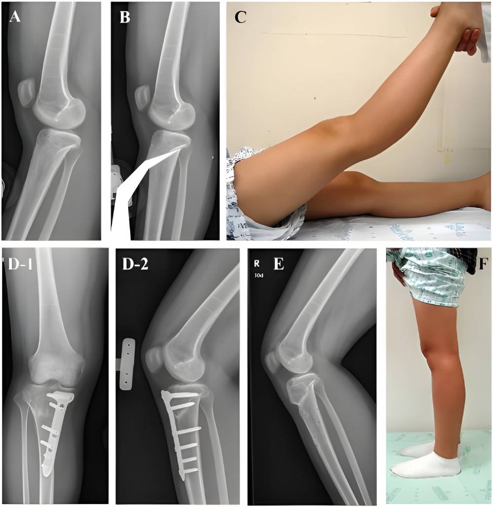 درمان عقب‌زدگی زانو با جراحی