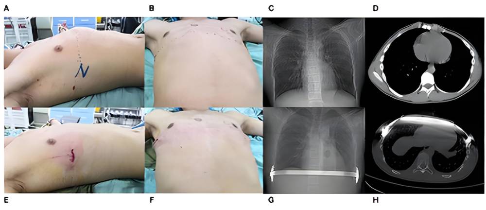 جراحی به روش NUSS معکوس برای درمان عارضه سینه کبوتری 