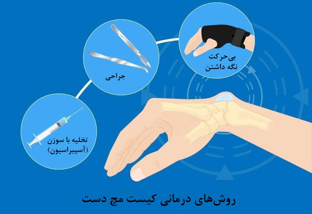 درمان کیست روی مچ دست