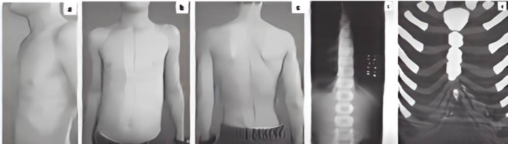 سینه کبوتری در اثر سندرم‌های ژنتیکی