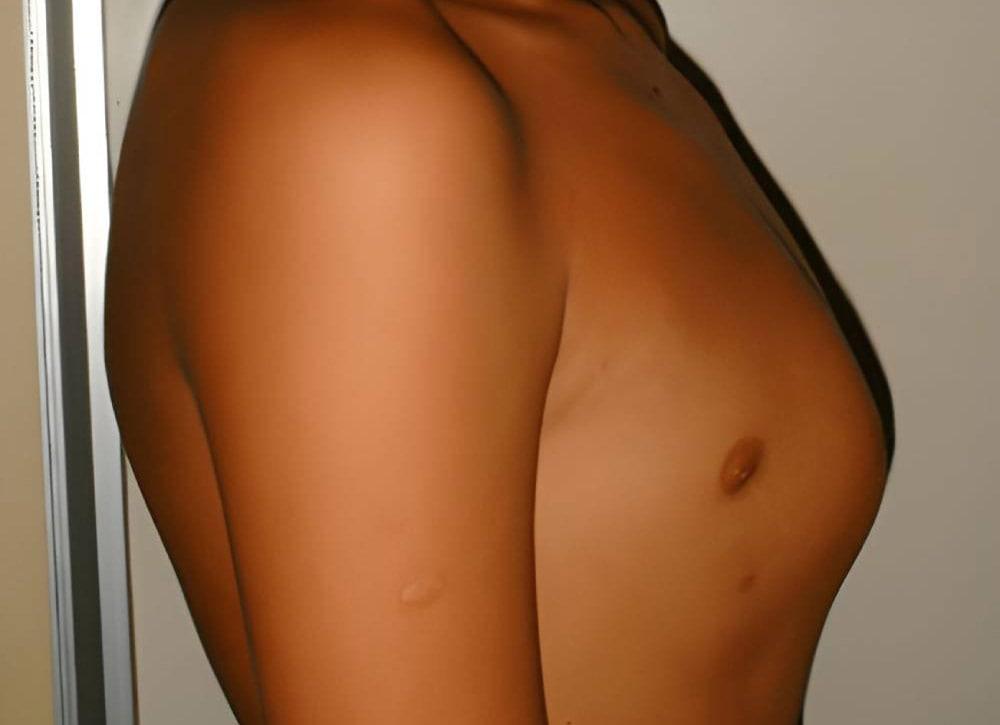 عارضه سینه کبوتری چیست و چه زمانی تشخیص داده می‌شود