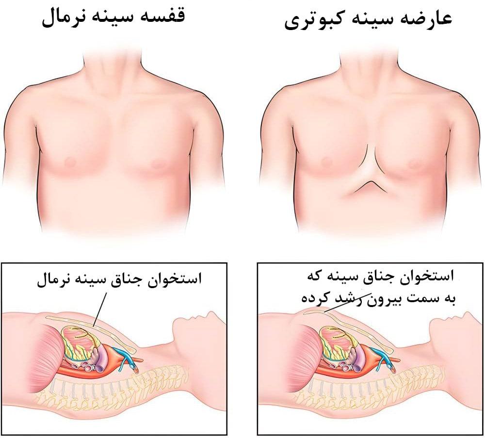 عارضه سینه کبوتری چیست و چه زمانی تشخیص داده می‌شود