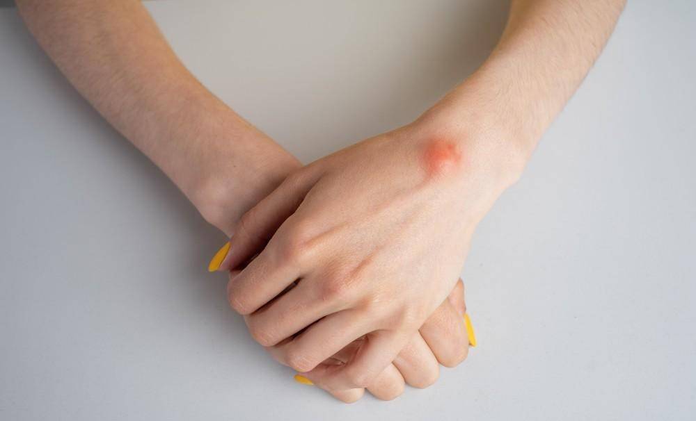 پارگی کیست مچ دست چیست؟