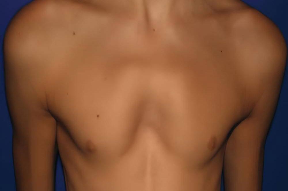 کندرومانوبریال از انواع سینه کبوتری