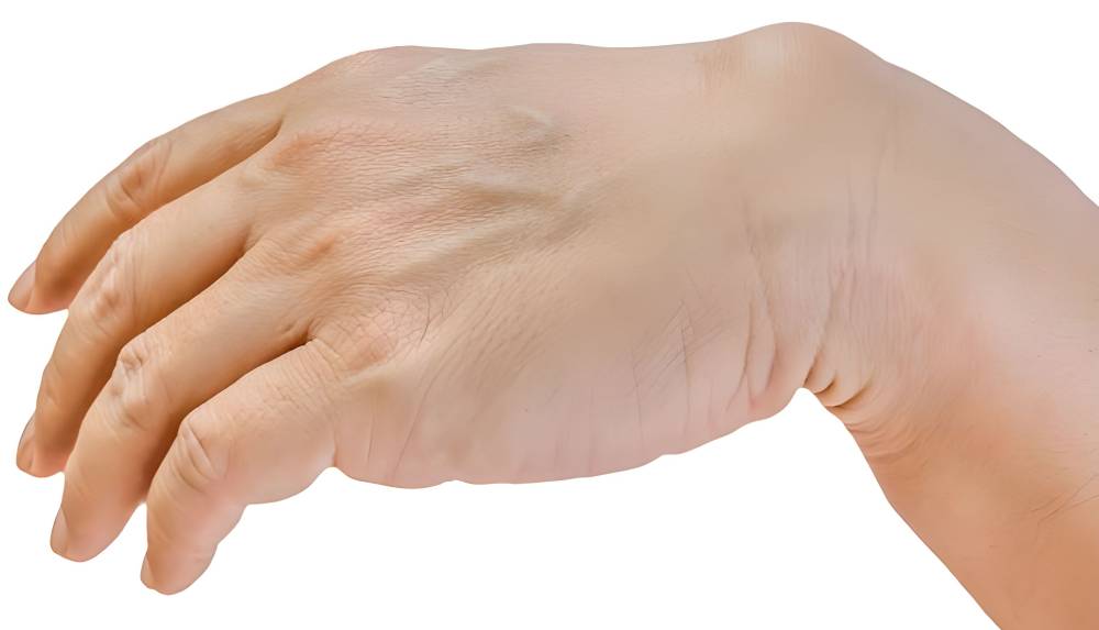 کیست گانگلیونی