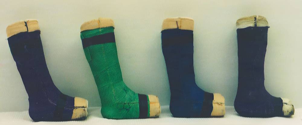 گچ گیری (Serial Casting) برای درمان راه رفتن روی پنجه پا