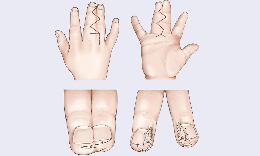 درمان چسبندگی انگشت در کودکان